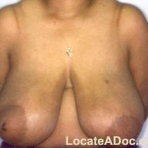 Free porn pics of Macromastia Gigantomastia 48 of 624 pics