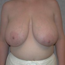 Free porn pics of Macromastia Gigantomastia 61 of 624 pics