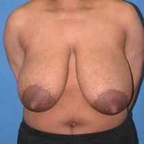 Free porn pics of Macromastia Gigantomastia 82 of 624 pics