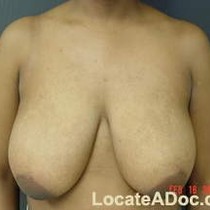 Free porn pics of Macromastia Gigantomastia 34 of 624 pics