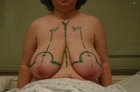 Free porn pics of Macromastia Gigantomastia 1 of 624 pics