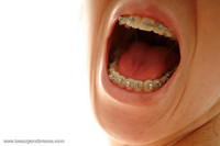 Free porn pics of Yellow teeth 2 91 of 199 pics